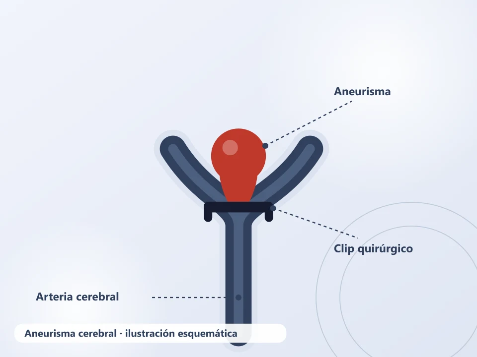 Ilustración de un aneurisma cerebral cerrado con un clip quirúrgico — qué hace un neurocirujano