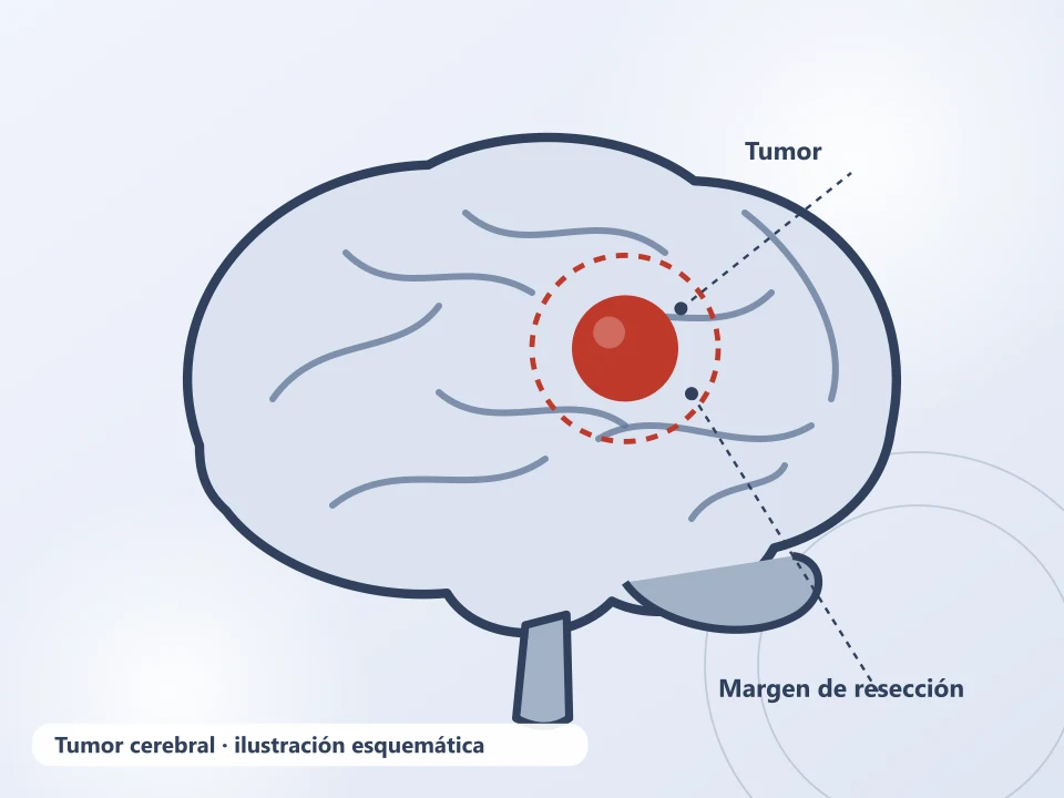 Ilustración de un tumor cerebral con su margen de resección — neurólogo o neurocirujano